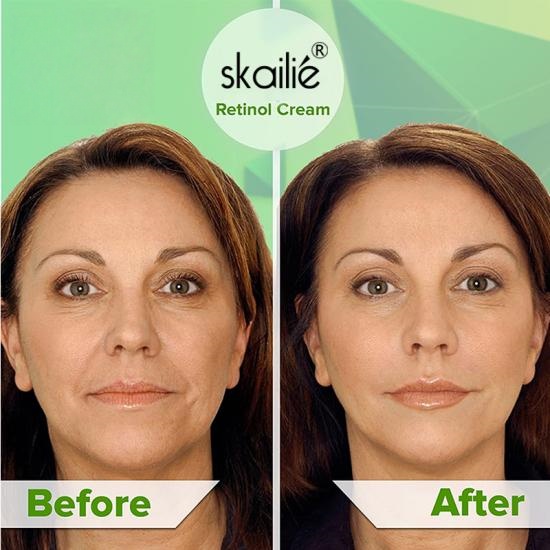 08aa1120ad604e328dfb5852572f9942_medium Retinol Moisturizing Face Cream Manufacturers,Professional Skincare Product Manufacturers - Image 5