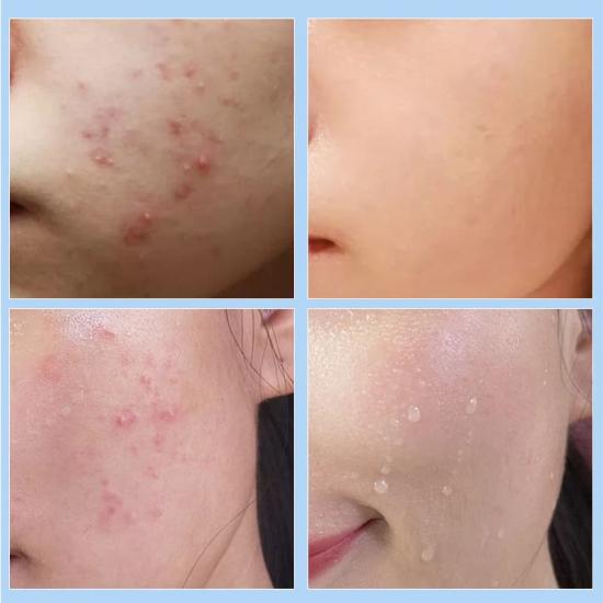 0cf35d520f58cdf0025b55102280dfef_medium Flower Shape Acne Patch Manufacturers,Professional Skincare Product Manufacturers - Image 2