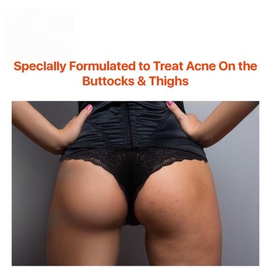 19501c404317ba4da138fb77a64c2429_medium Acne Treatment Peel Pads Manufacturers,Professional Skincare Product Manufacturers - Image 4