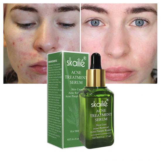 2ff954231238ded87d6201adc2d7aaa4_medium Acne Treatment Serum Manufacturers,Professional Skincare Product Manufacturers - Image 3
