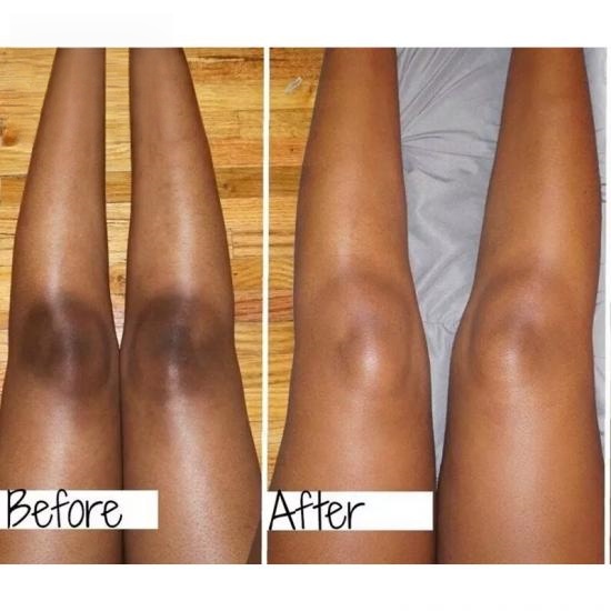 51ee7b857a6f2476da074e6535556e32_medium Skailie Knees And Elbows Whitening Cream Manufacturers,Professional Skincare Product Manufacturers - Image 4