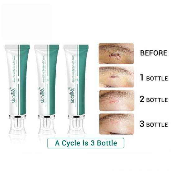 9c689f69334b9d9814365b0a53888361_medium Acne Scar Removal Cream Manufacturers,Professional Skincare Product Manufacturers - Image 2