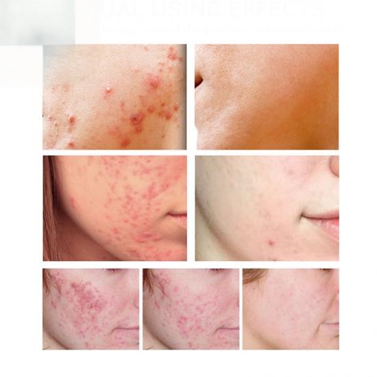 aed235e393ff4033ea18e799b6c71161_medium Acne Treatment Serum Manufacturers,Professional Skincare Product Manufacturers - Image 5