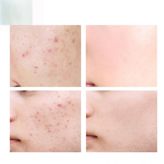 de2ca303a13f7f2f2e55d1ffb5f59002_medium Acne Scar Removal Gel Manufacturers,Professional Skincare Product Manufacturers - Image 4