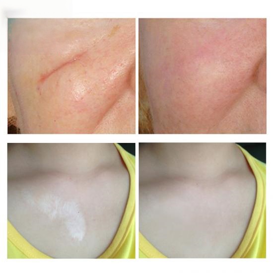 e4bed0a06a738d1ee97918989cd55f6d_medium Acne Scar Removal Cream Manufacturers,Professional Skincare Product Manufacturers - Image 5