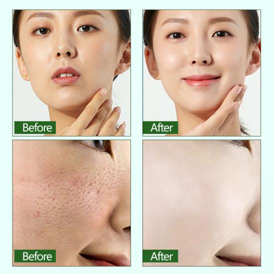 f47efccdc4b45c07d6338675e83cf239_medium Skailie Tea Tree Pore Shrinking Serum Manufacturers,Professional Skincare Product Manufacturers - Image 5